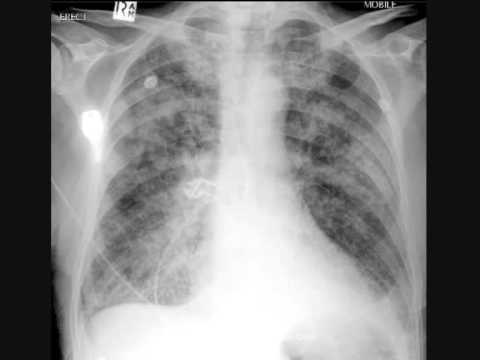 Profilový obrázek - Chest x-ray interpretation, pulmonary edema, heart attack