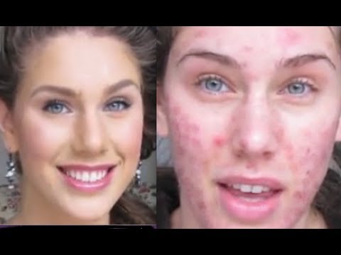 Profilový obrázek - Foundation Routine Flawless Skin (Full Coverage, Fingertips) Acne Scaring
