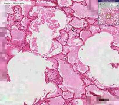 Profilový obrázek - Histopathology Lung --Acute pulmonary edema, Asbestos bodies
