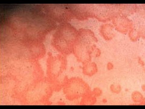 Profilový obrázek - How to Treat Hives [DermTV.com Epi #285]