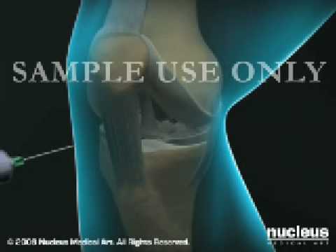 Profilový obrázek - Lifenet Tissue Graft Knee Cartilage
